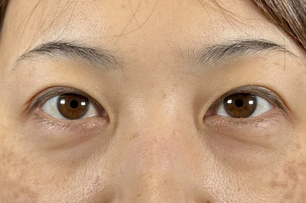 脱脂の適応？表ハムラが適応？裏ハムラが適応？